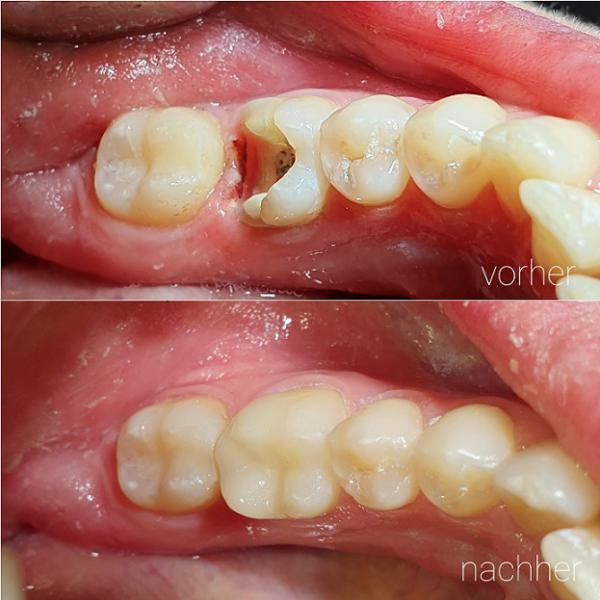 Chairside Versorgung (CEREC)